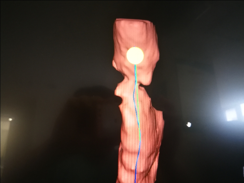 经支气管镜球囊扩张治疗气道狭窄,支气管镜球囊扩张操作视频