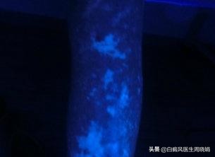 白斑植皮手术,白斑做手术