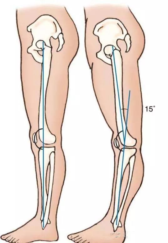 科普|膝盖后侧疼痛的无力感，到底该怎么应对？