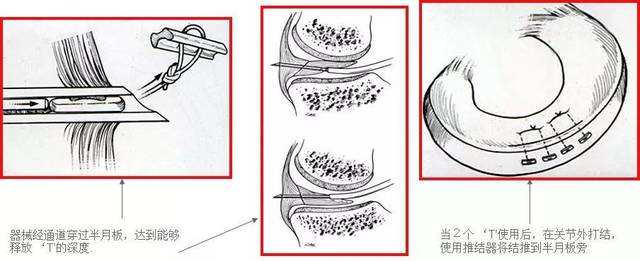 半月板手术修复去哪里做,半月板手术治疗有微创吗
