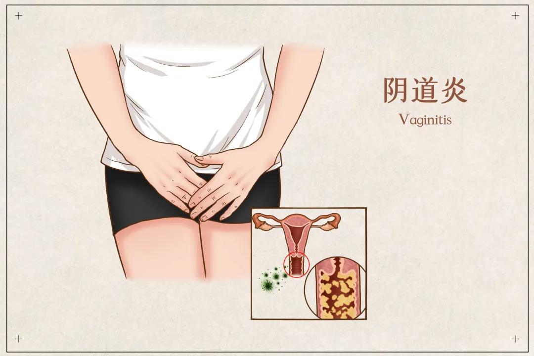 阴道炎女性有啥症状,女性阴道炎有什么症状吗