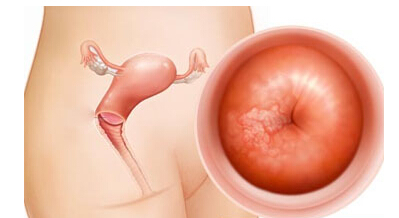 宫颈癌变的根源,宫颈腺体感染癌变