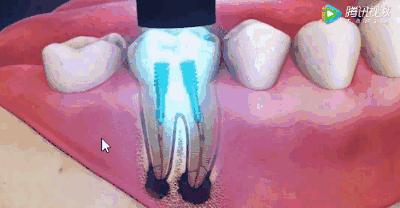 根管治疗可怕,根管治疗很恐怖吗