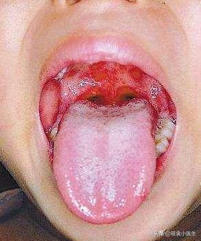 手足口病容易和哪些病混淆,儿科医生手足口病