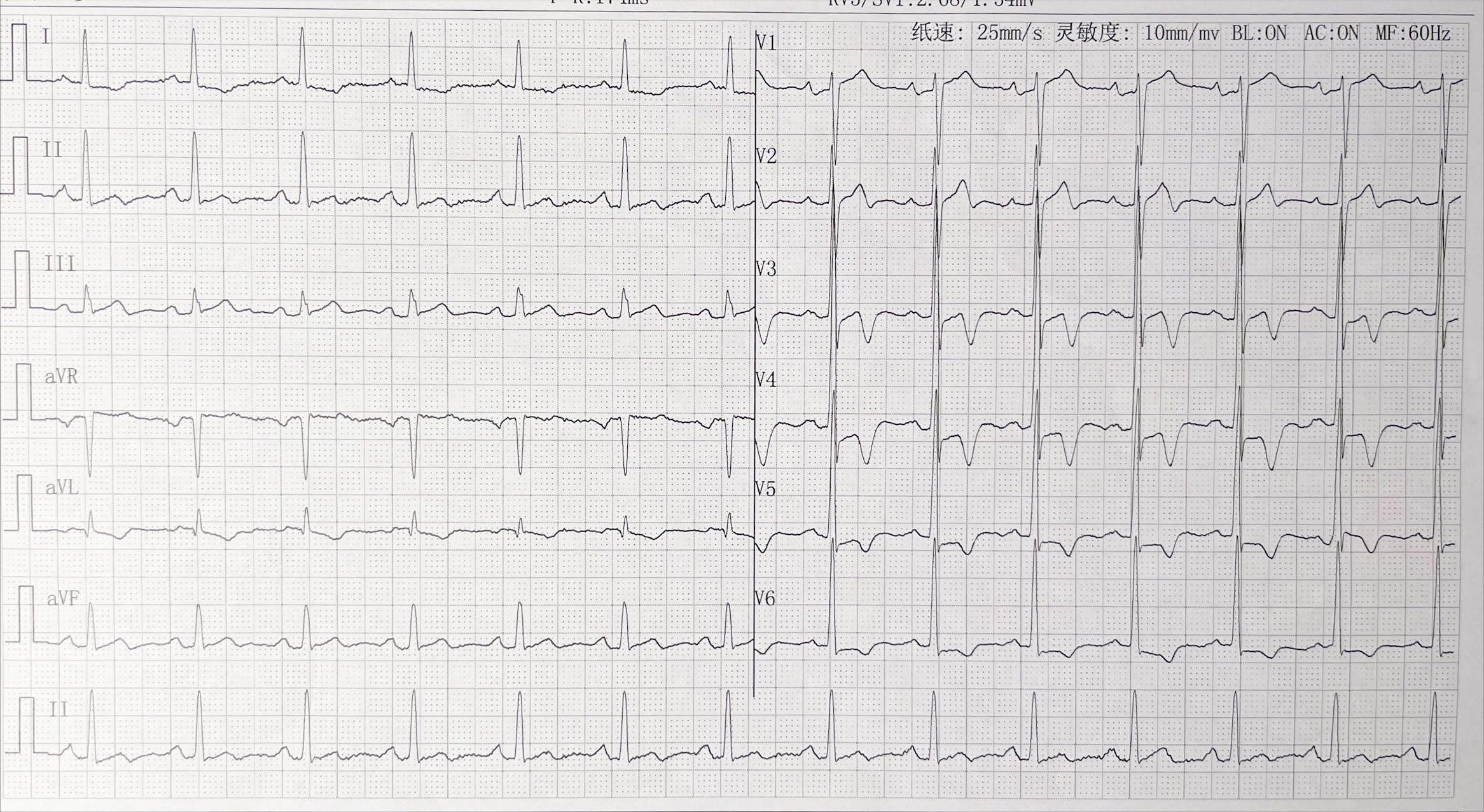 胸闷气短心电图有变化,冠脉造影正常但有胸闷心绞痛症状