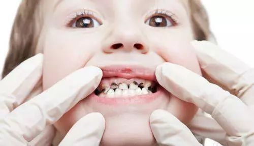 小孩得了奶瓶龋该怎么治疗,宝宝牙齿奶瓶龋怎样治