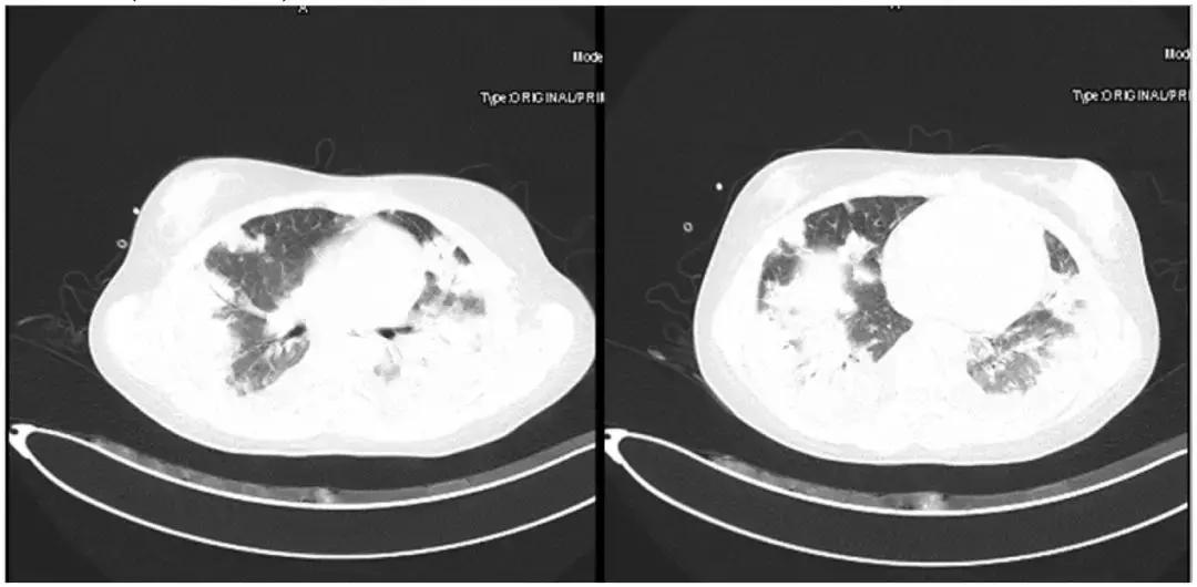 万古霉素治疗mrsa疗程,万古霉素用于mrsa的作用机制