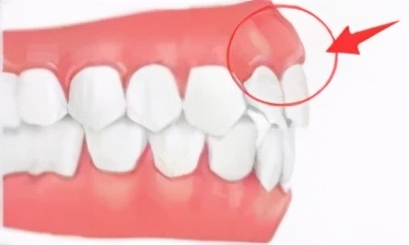 突嘴正颌手术有哪些风险,正颌手术凸嘴3d动画演示