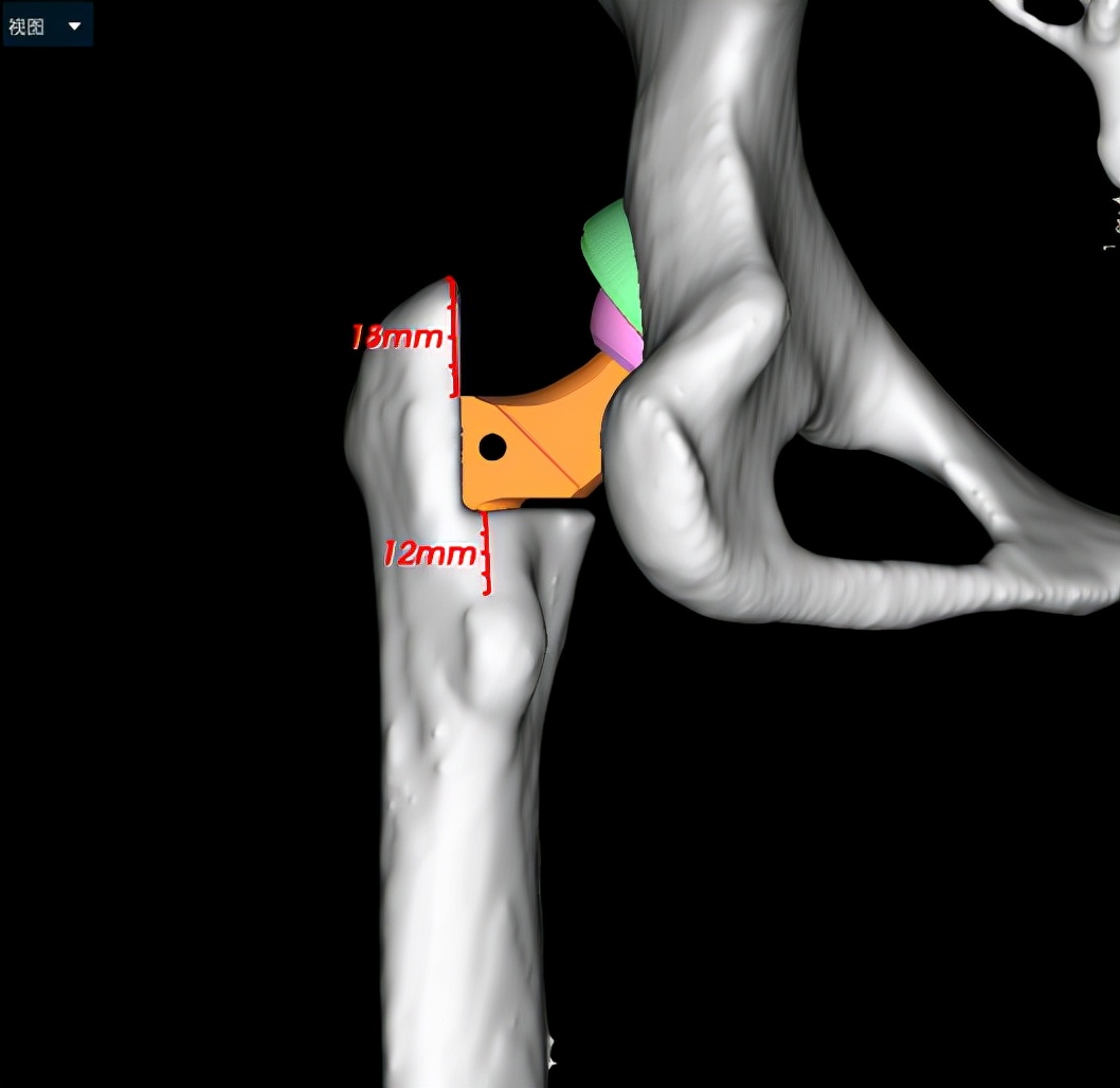 AI助力精准处理IV型髋关节发育不良花季少女翻开人生新篇章