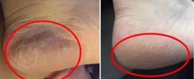 冬天脚跟干裂又起皮怎么办,冬天脚跟干裂起硬皮擦什么保湿好