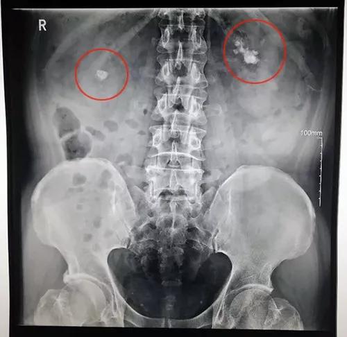 双肾多发结石怎么取干净,双镜联合下胆囊切开取石术
