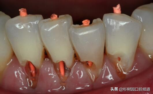 pmtc洗牙和普通洗牙有什么区别吗,39.9洗牙和150洗牙有什么区别