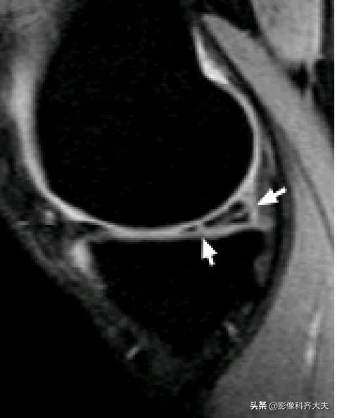 膝关节半月板损伤的磁共振,膝关节半月板病变的mri诊断与鉴别