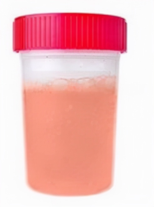 尿液颜色像茶褐色中医辨证,尿液颜色可以判断肾健康