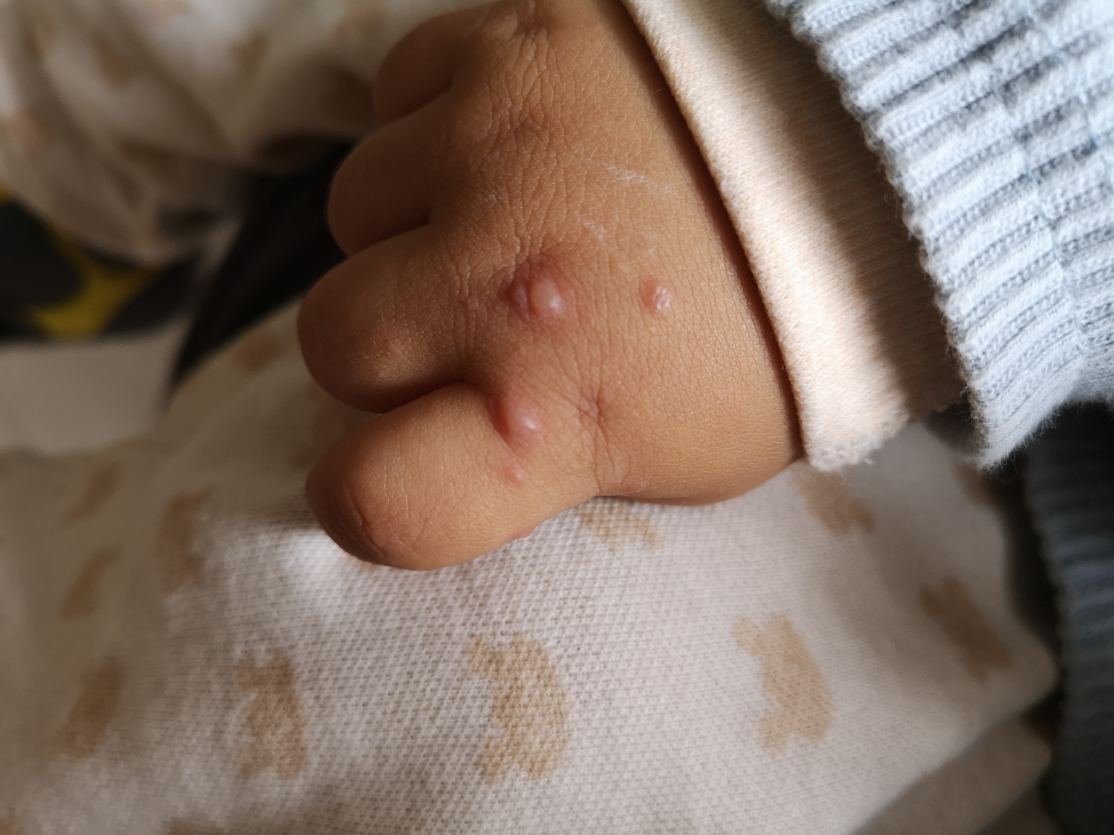 手足口疱疹性咽颊炎进入高发期,手足口高发期孩子有什么症状