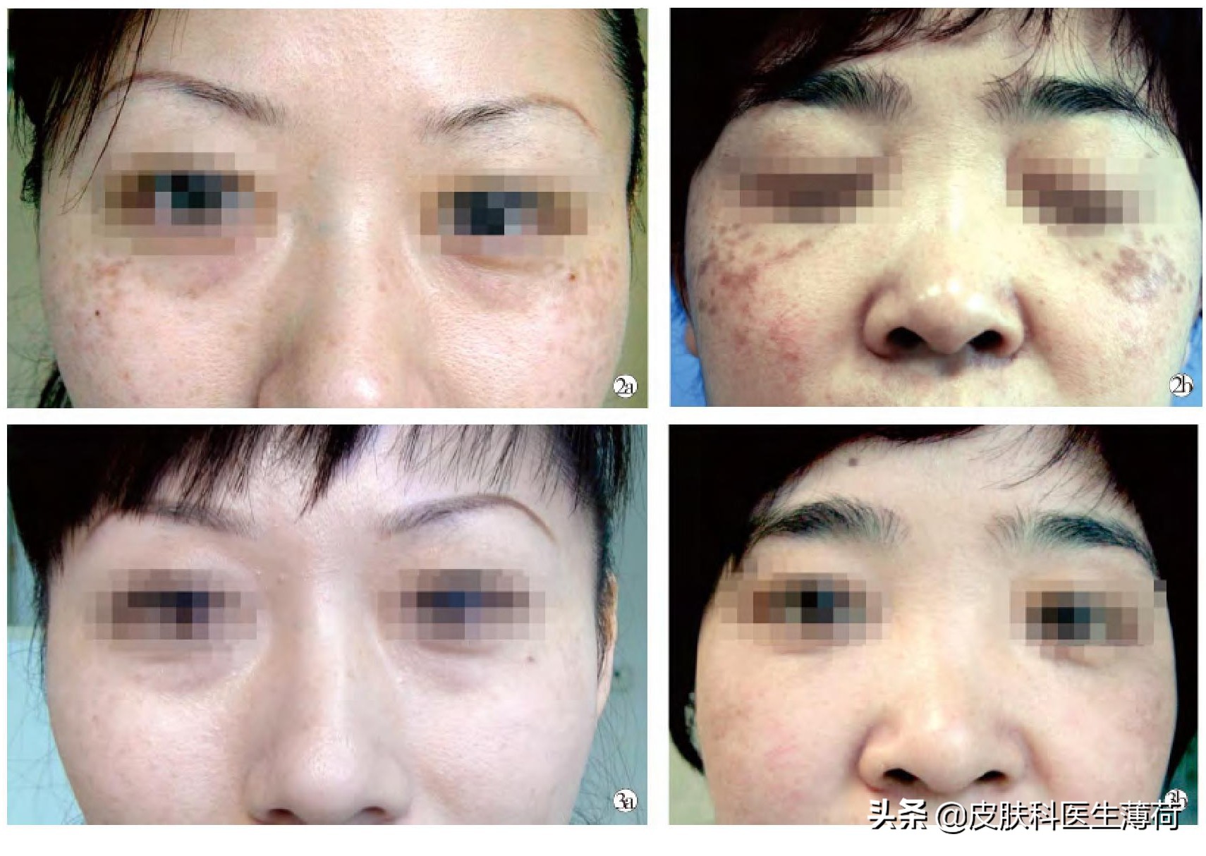 祛斑祛红色痘印激光,点阵激光祛斑仪器