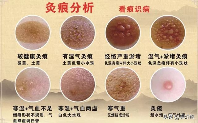 艾灸后感觉人瘦了,艾灸了一段时间人好像瘦了一圈