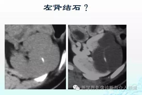 ct造影剂过敏反应及处理方法,增强ct碘过敏该用什么造影剂