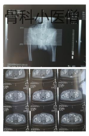 老人髋骨置换术后脱位如何处理,90岁老人摔断髋关节怎么办