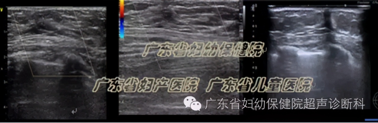 青春期乳腺正常情况,乳腺发育的特征