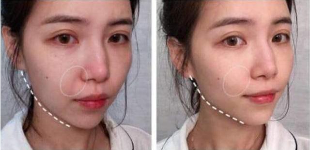 100人里就有20人中招，清洁不到位导致脸上冒虫，毛孔需要早清洁