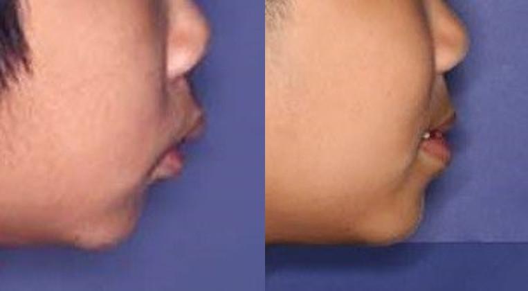 雅悦齿科,做了牙齿矫正容易得牙龈萎缩吗