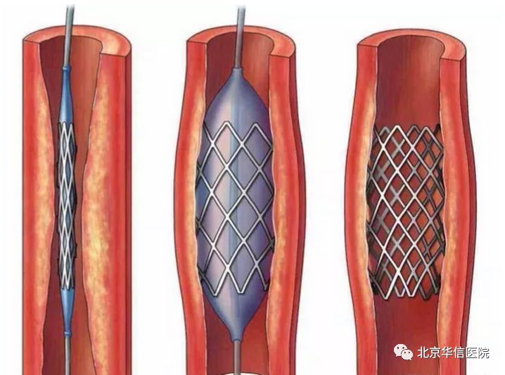吃了一片硝酸甘油差点死掉,硝酸甘油一下吃了六片