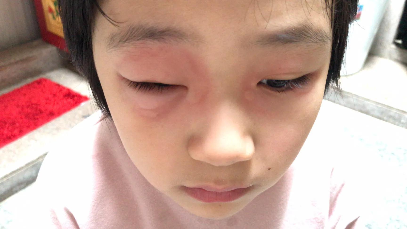 儿童发烧吃美林过敏什么原因,儿童发烧喝美林浑身起疙瘩