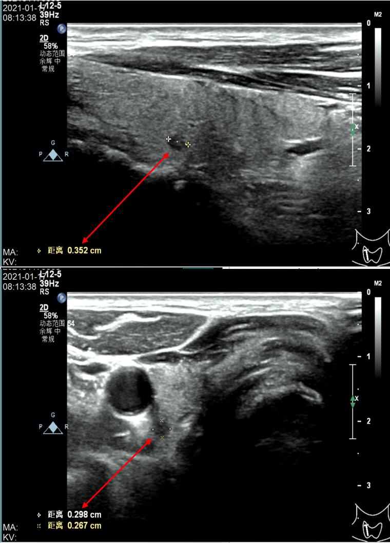 甲状腺右残叶再发3.5毫米（芝麻粒大小）结节，何去何从？
