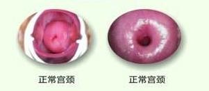 出血十天是宫颈癌吗,绝经后出血可能是宫颈癌