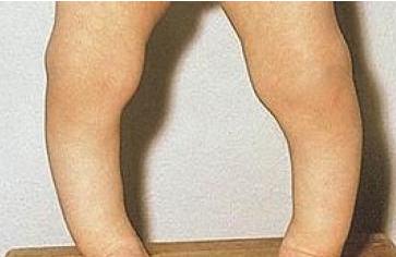 孩子佝偻病的表现怎么治疗,小孩佝偻病是什么原因引起的