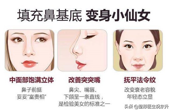 自体脂肪填充法令纹亲身经历,法令纹是不是出现了才能填充