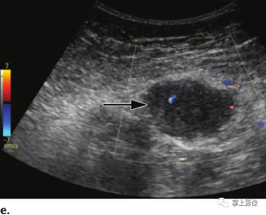 腹壁病变诊断思路,腹部影像诊断读片入门视频