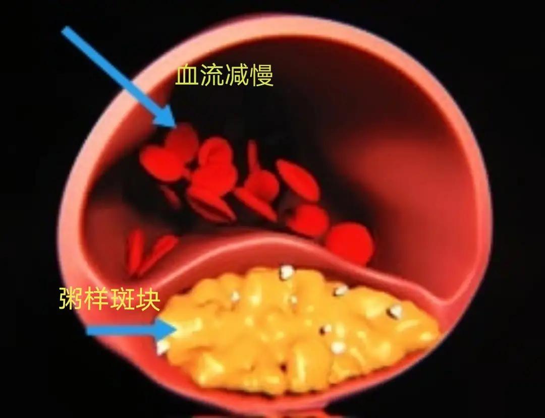 颈动脉硬化吃什么药可以消除斑块,颈动脉硬化并斑块形成怎么处理