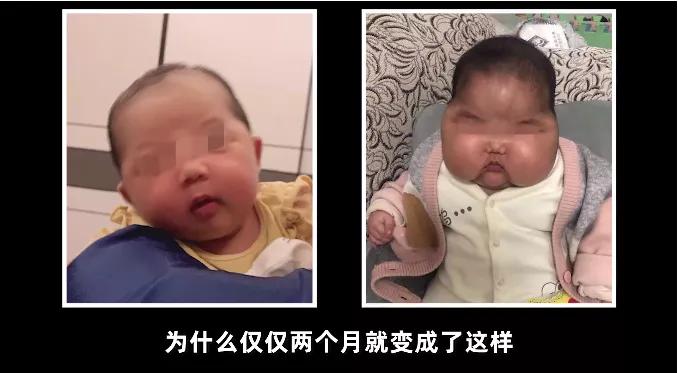 婴儿湿疹可以擦激素的药膏么,婴儿湿疹可以用激素膏吗