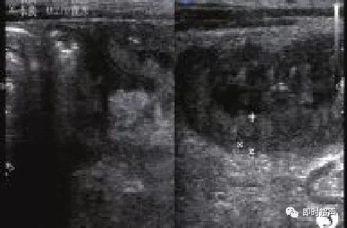 小儿消化道急症超声