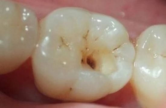 儿童一颗恒牙长一半很久不长了,19岁乳牙不掉不长恒牙的危害