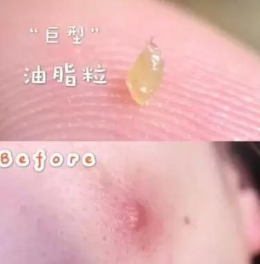 脸上粉刺留下硬块怎么去除,脸上一粒粒的粉刺怎么消除