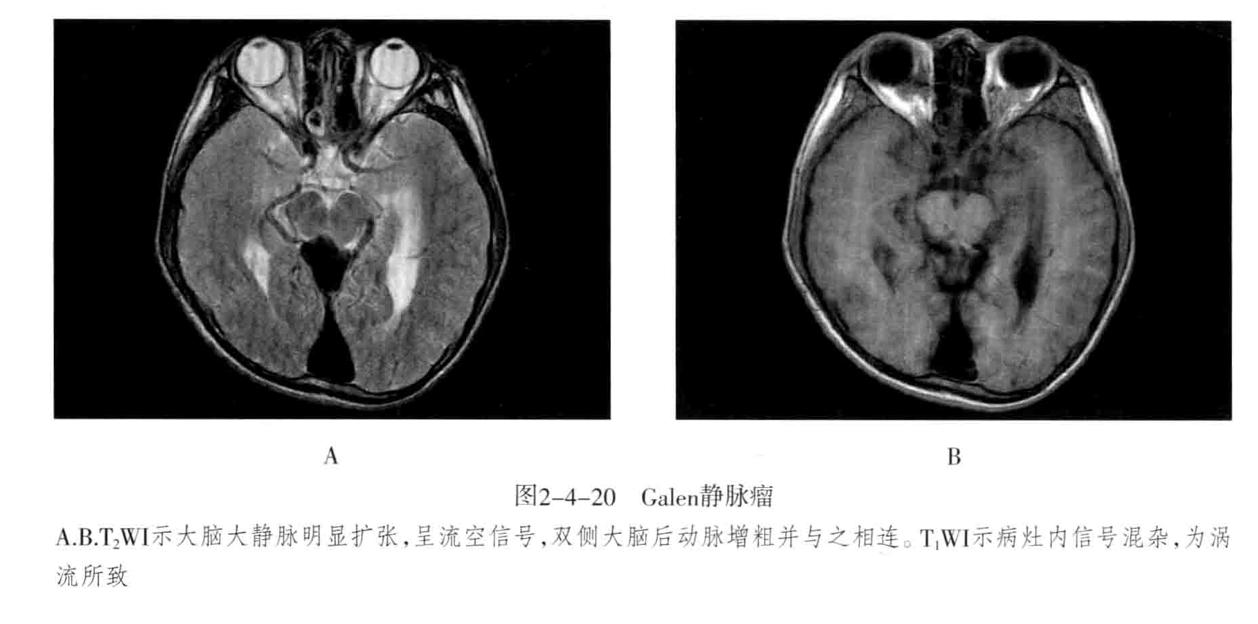 颅内血管周围间隙的影像鉴别,颅脑血管源性疾病影像诊断