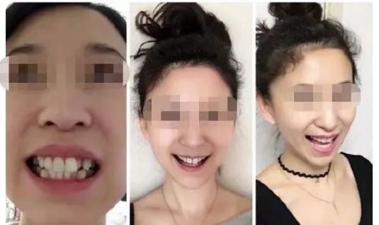 国家有关于牙齿的补贴吗,牙齿补贴报销政策