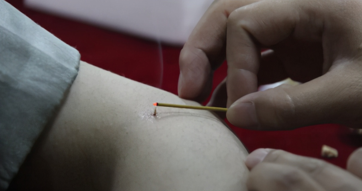 盲目艾灸危害健康,艾灸盲目灸坏身体的案例