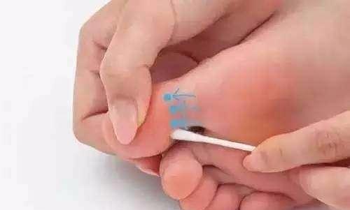 一个小妙招全身的痛都能治,一根棉签的效果视频