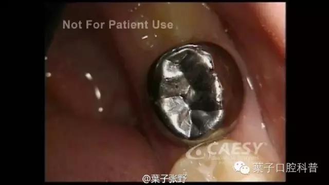 牙龈反复鼓包流脓是牙齿坏了吗,一上火牙龈就鼓包