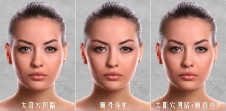 面部填充到底推荐做吗,面部填充脸部凹陷有风险吗