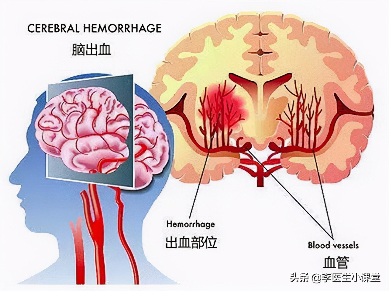 家人脑出血了安全了怎么安慰,家人突发脑溢血的急救措施