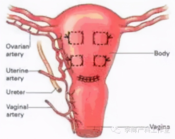 子宫收缩乏力引起产后出血的综述,宫缩乏力性产后出血的诊治建议