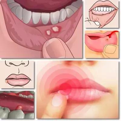 医保城健康网｜不可小看的口腔溃疡！