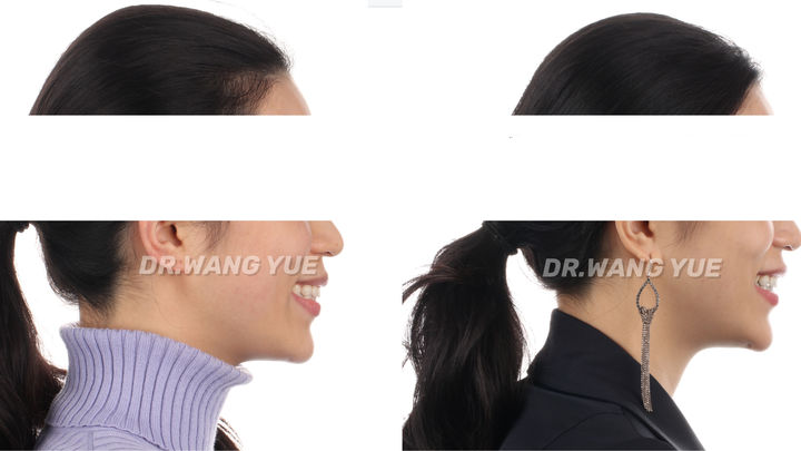 上海口腔医院牙齿矫正牙缝,上海牙齿畸形龅牙矫正