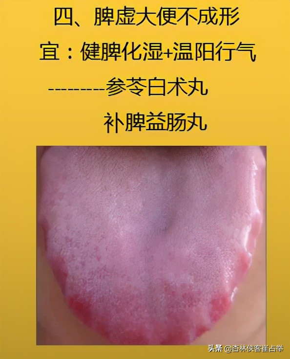 生理性齿痕舌与病理性齿痕舌,齿痕舌形成的原因是脾虚还是瘀血