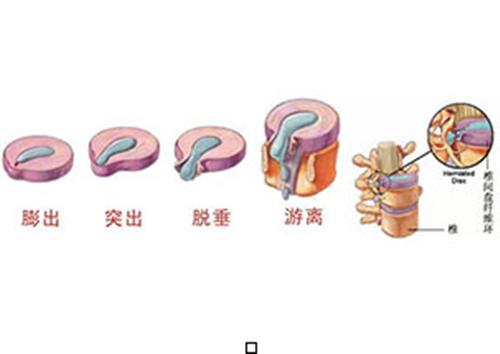 做什么锻炼,可以缓解腰椎间盘膨出